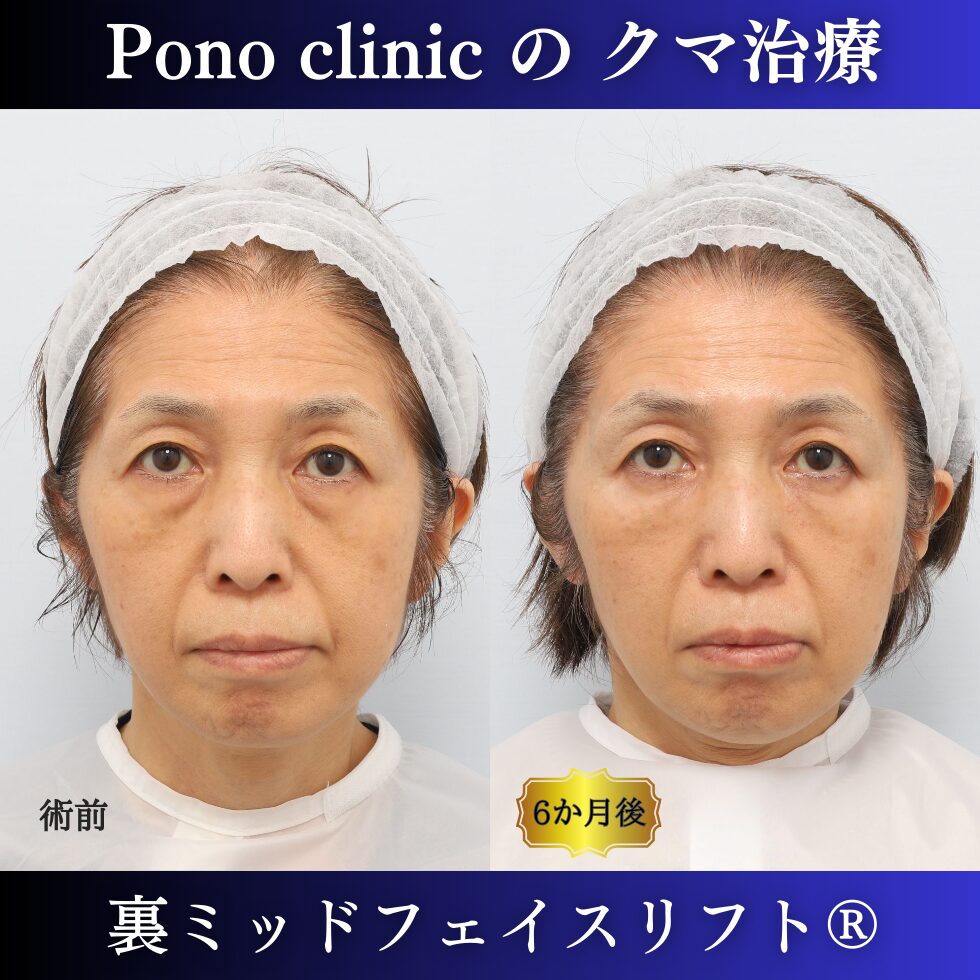 目の下のクマ取り、裏ハムラ法、50代女性の症例