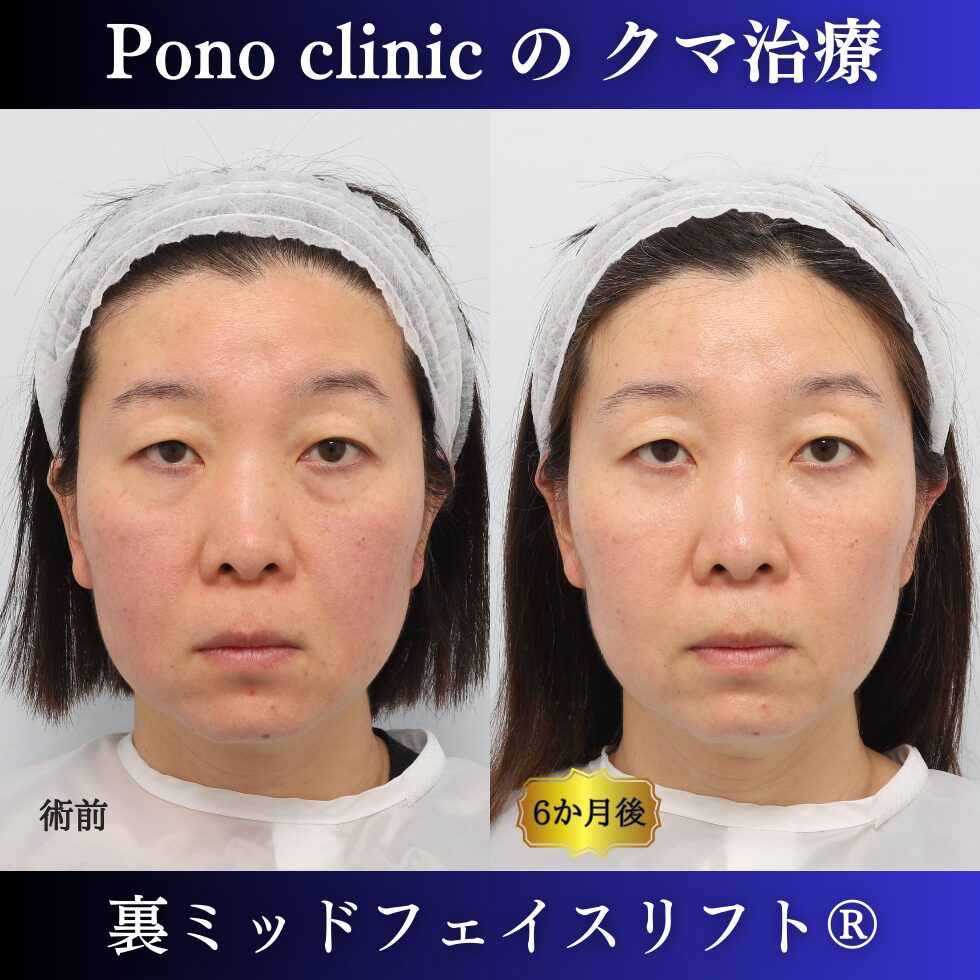 4 40代女性、目の下のクマ取り、裏ミッドフェイスリフト、裏ハムラ