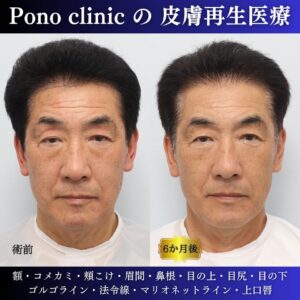 60代男性の症例、若返り治療、PRPF療法、法令線治療、しわ取り (4)