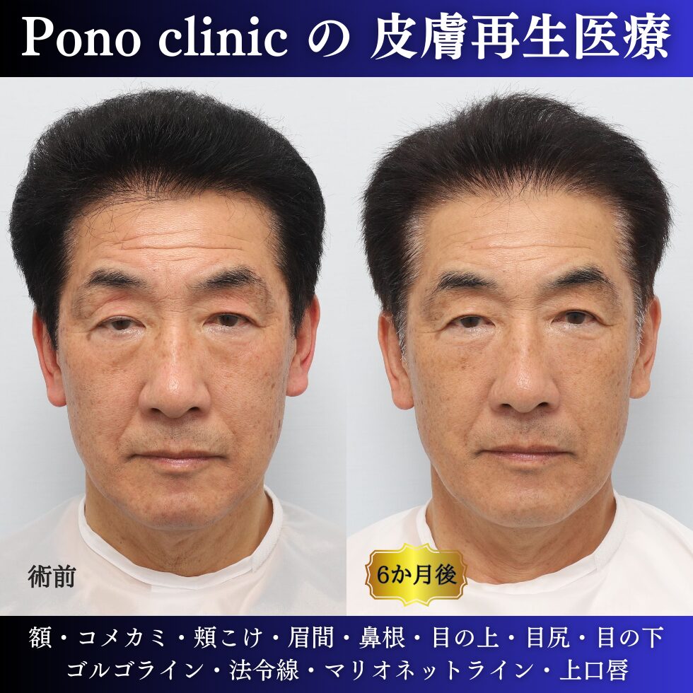 60代男性の症例、若返り治療、PRPF療法、法令線治療、しわ取り (4)
