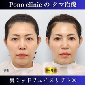 40代の症例、目の下のクマ取り、裏ハムラ法、ミッドフェイスリフト
