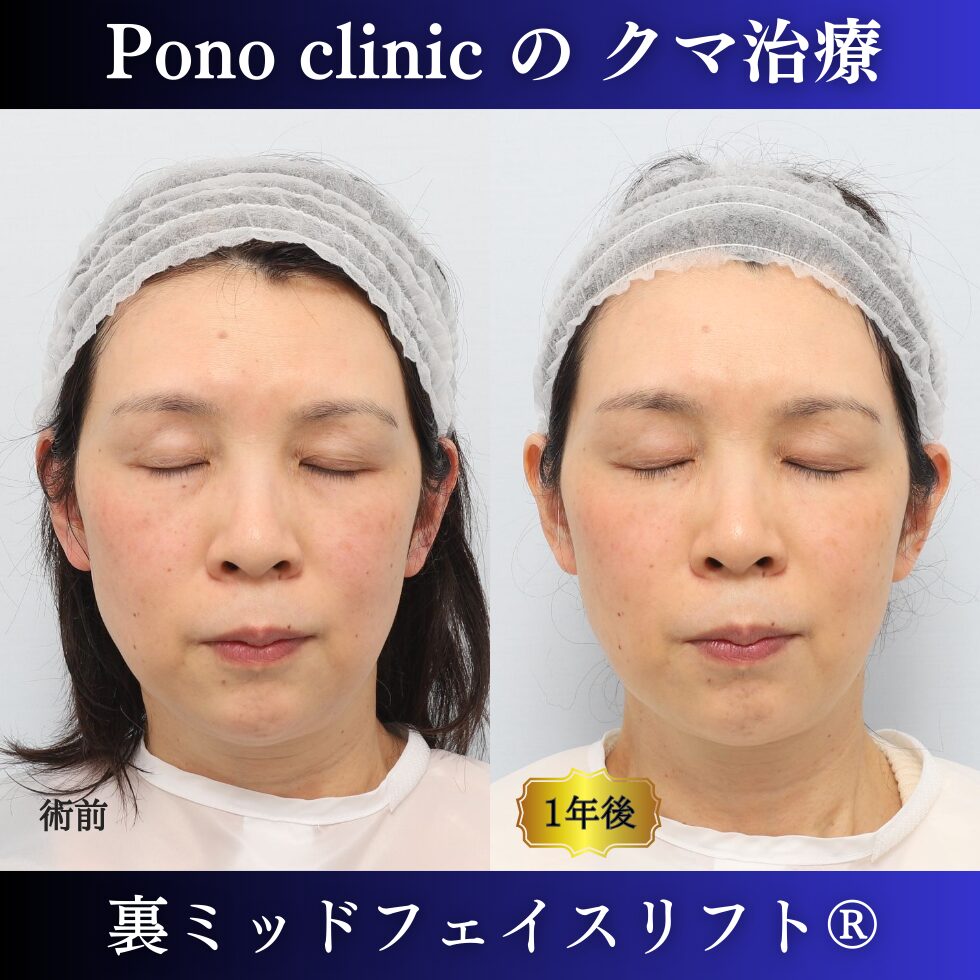 裏ミッドフェイスリフト