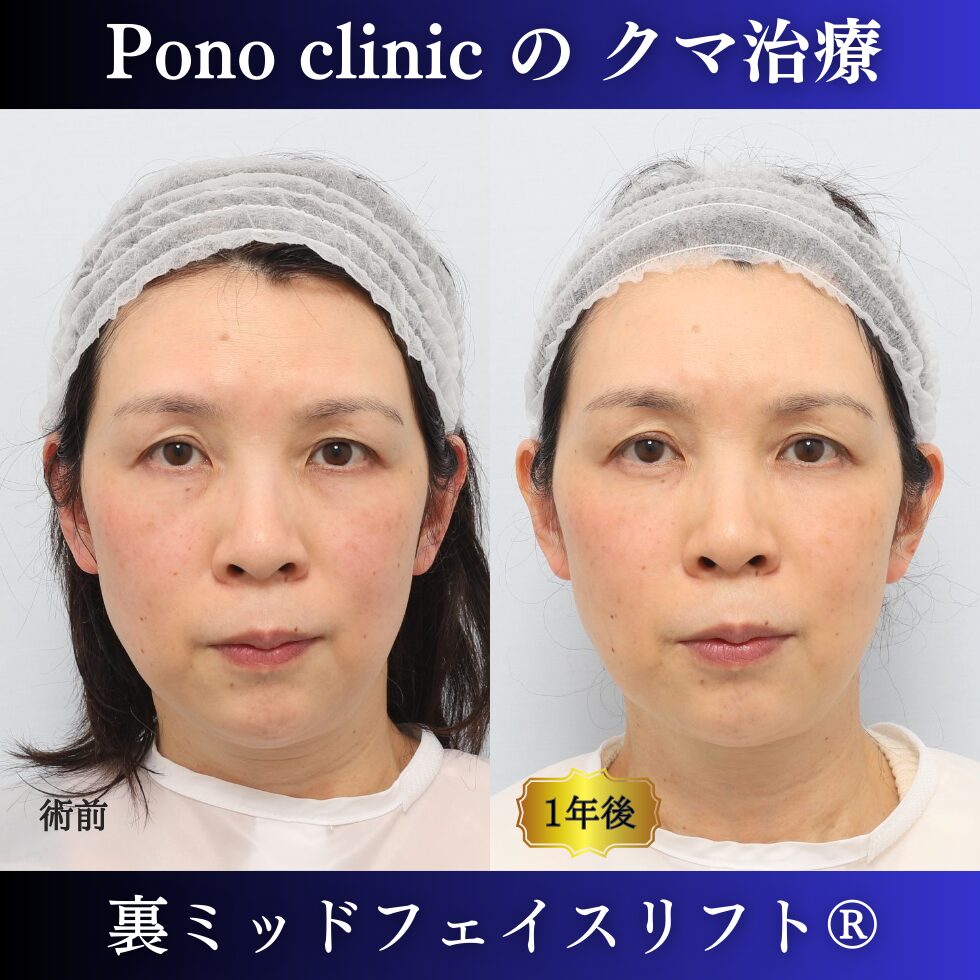 裏ミッドフェイスリフト