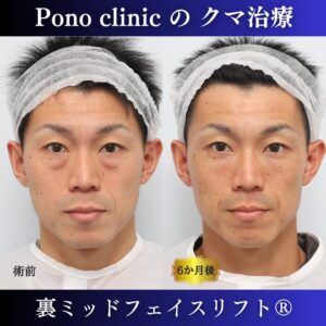 裏ミッドフェイスリフト