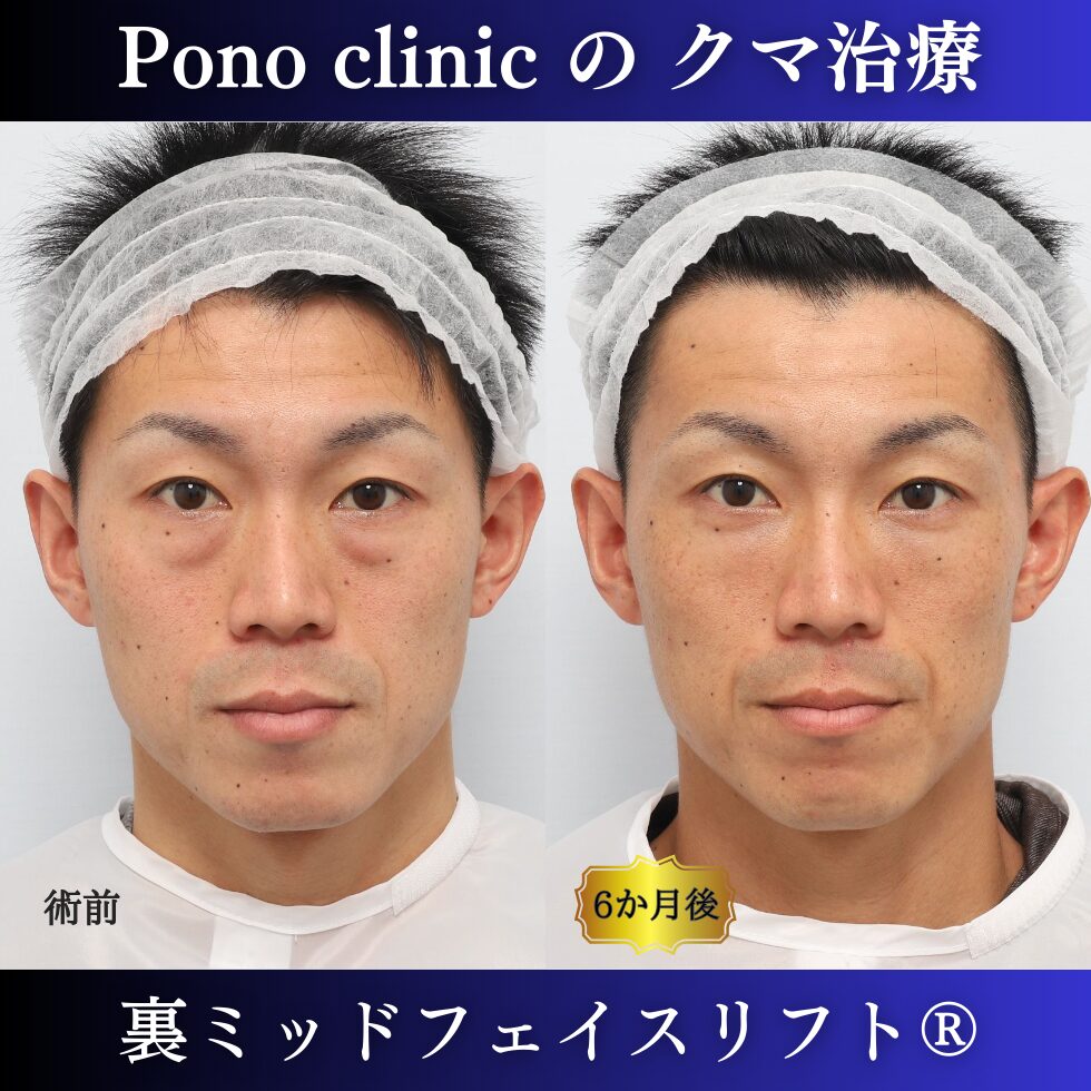 裏ミッドフェイスリフト