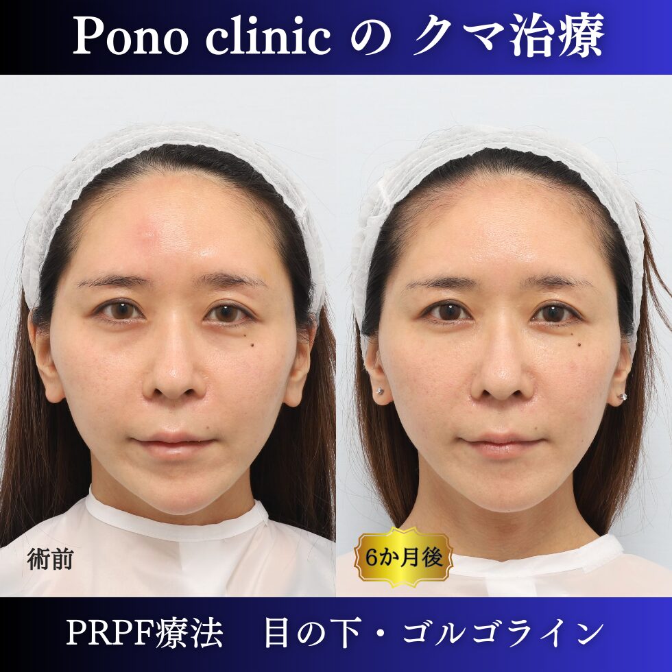 目の下のクマ、PRPF療法、ゴルゴライン