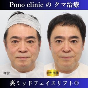 50代男性、目の下のクマ 、裏ハムラ、ミッドフェイスリフト、裏ミッドフェイスリフトの症例
