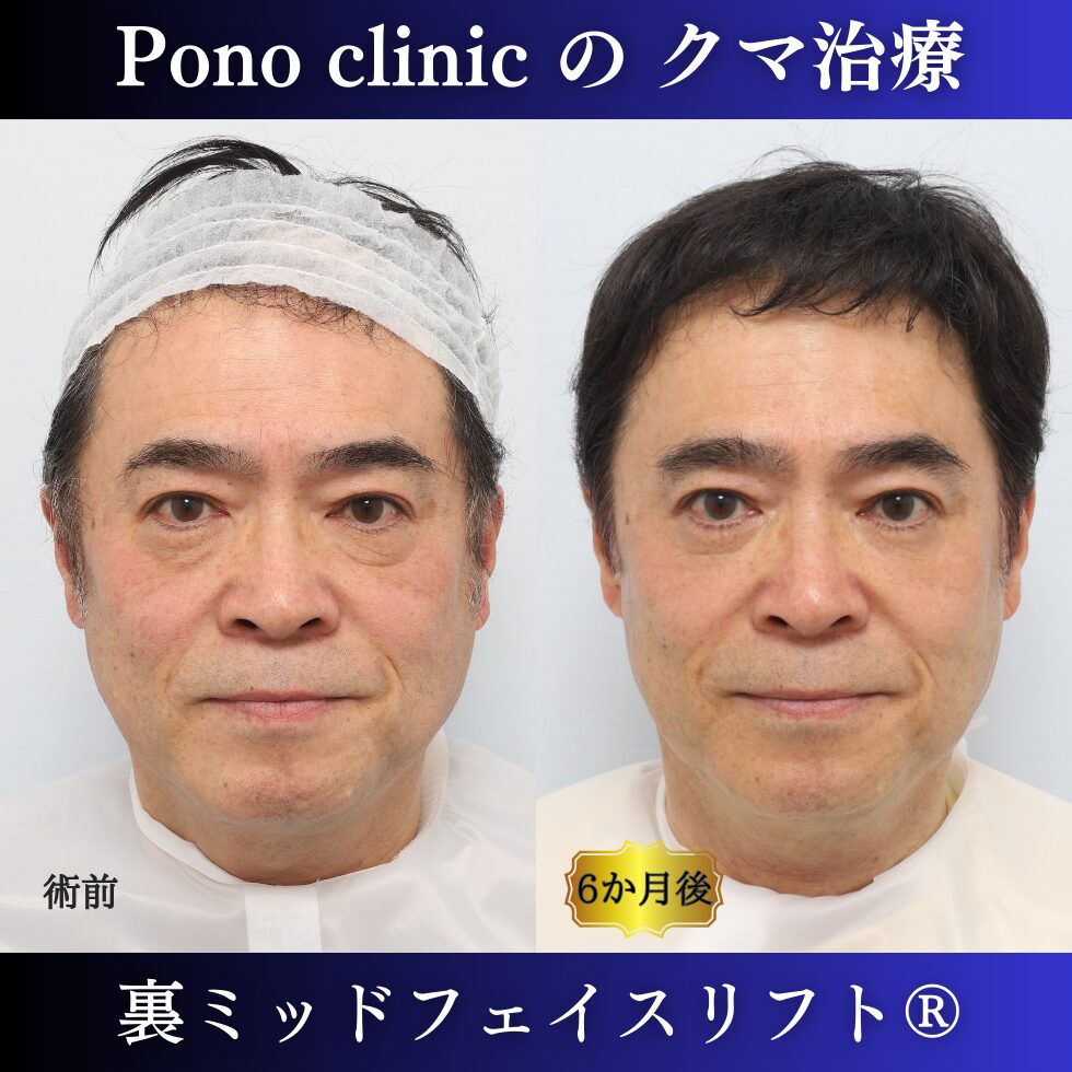 50代男性、目の下のクマ 、裏ハムラ、ミッドフェイスリフト、裏ミッドフェイスリフトの症例