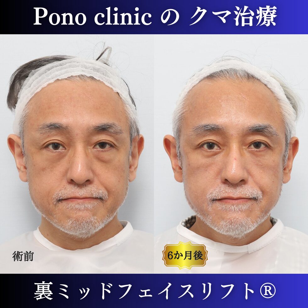 裏ミッドフェイスリフト