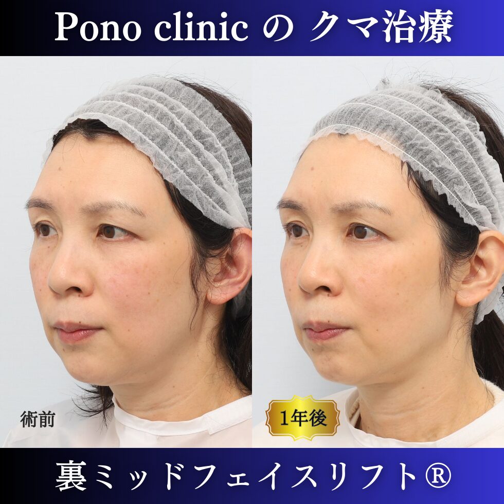 裏ミッドフェイスリフト