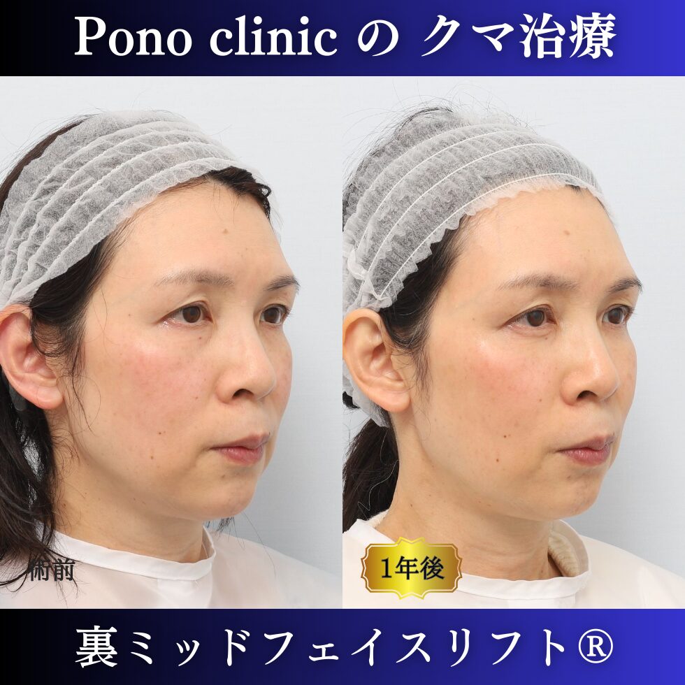 裏ミッドフェイスリフト