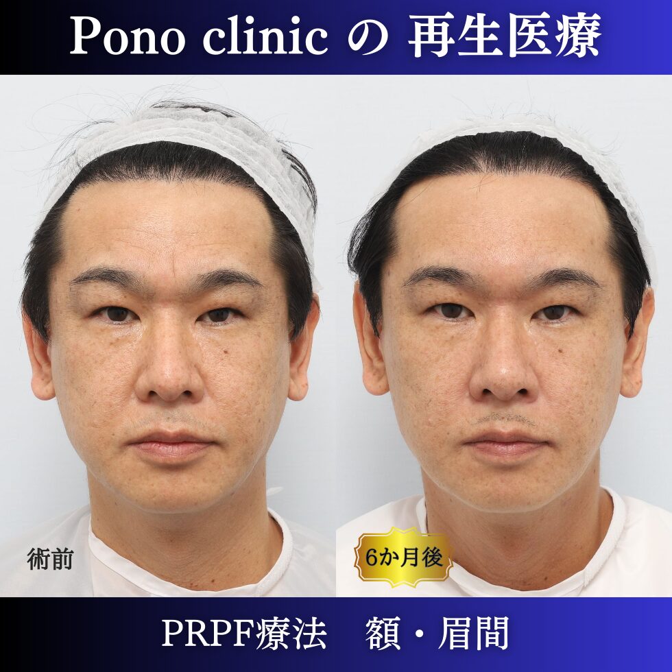 眉間のしわ、額のしわ、PRPF療法