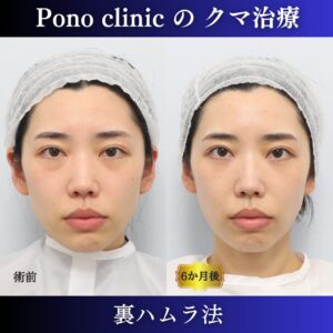 裏ハムラ法
