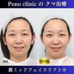 裏ミッドフェイスリフト