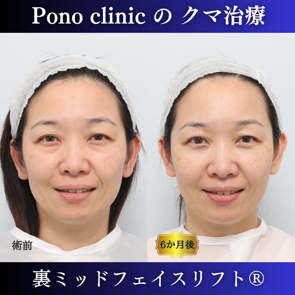 裏ミッドフェイスリフト