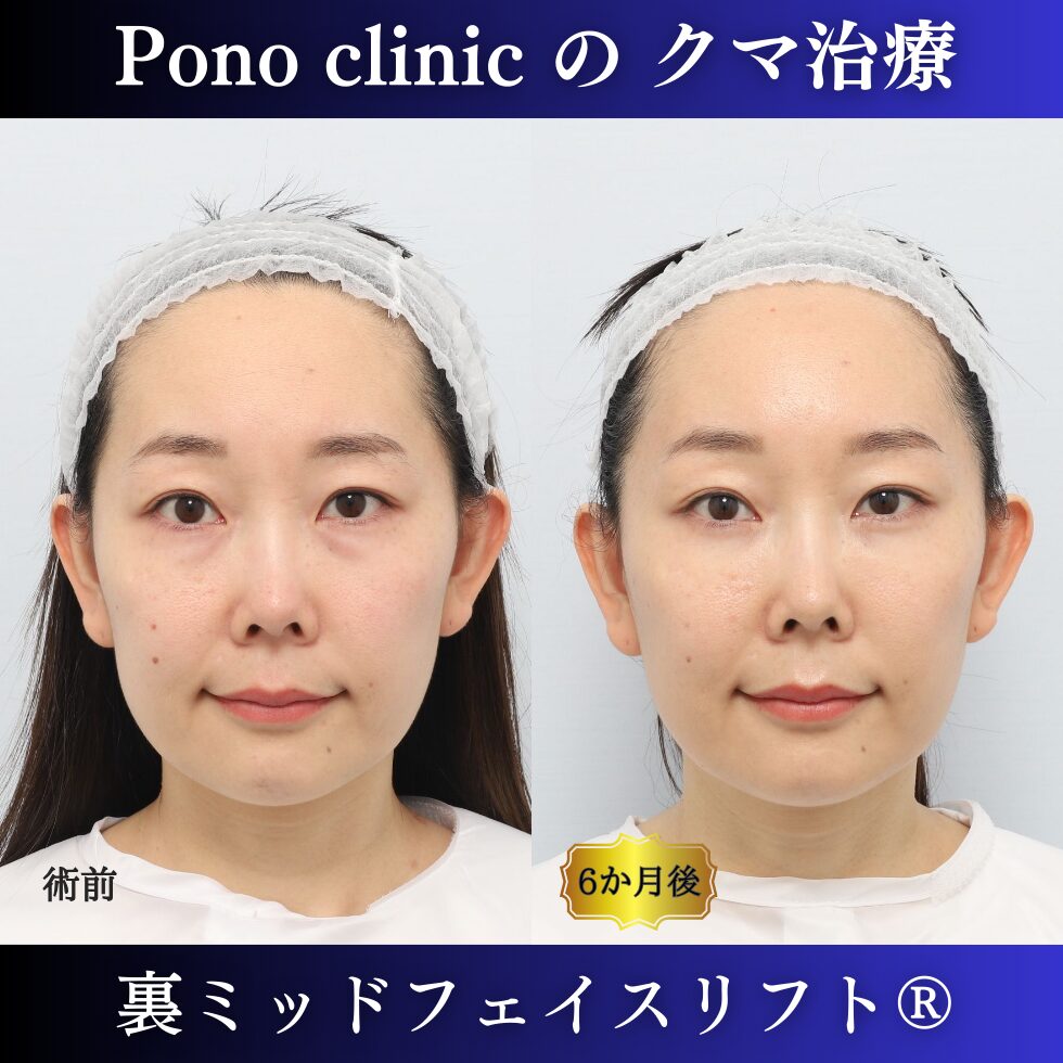 裏ミッドフェイスリフト