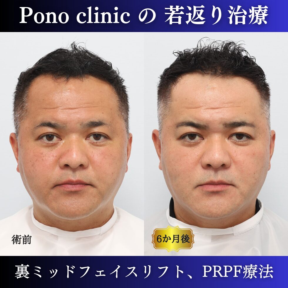 裏ミッドフェイスリフト、PRPF療法