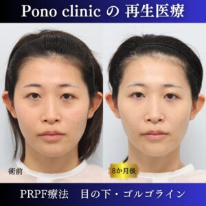 PRPF療法
