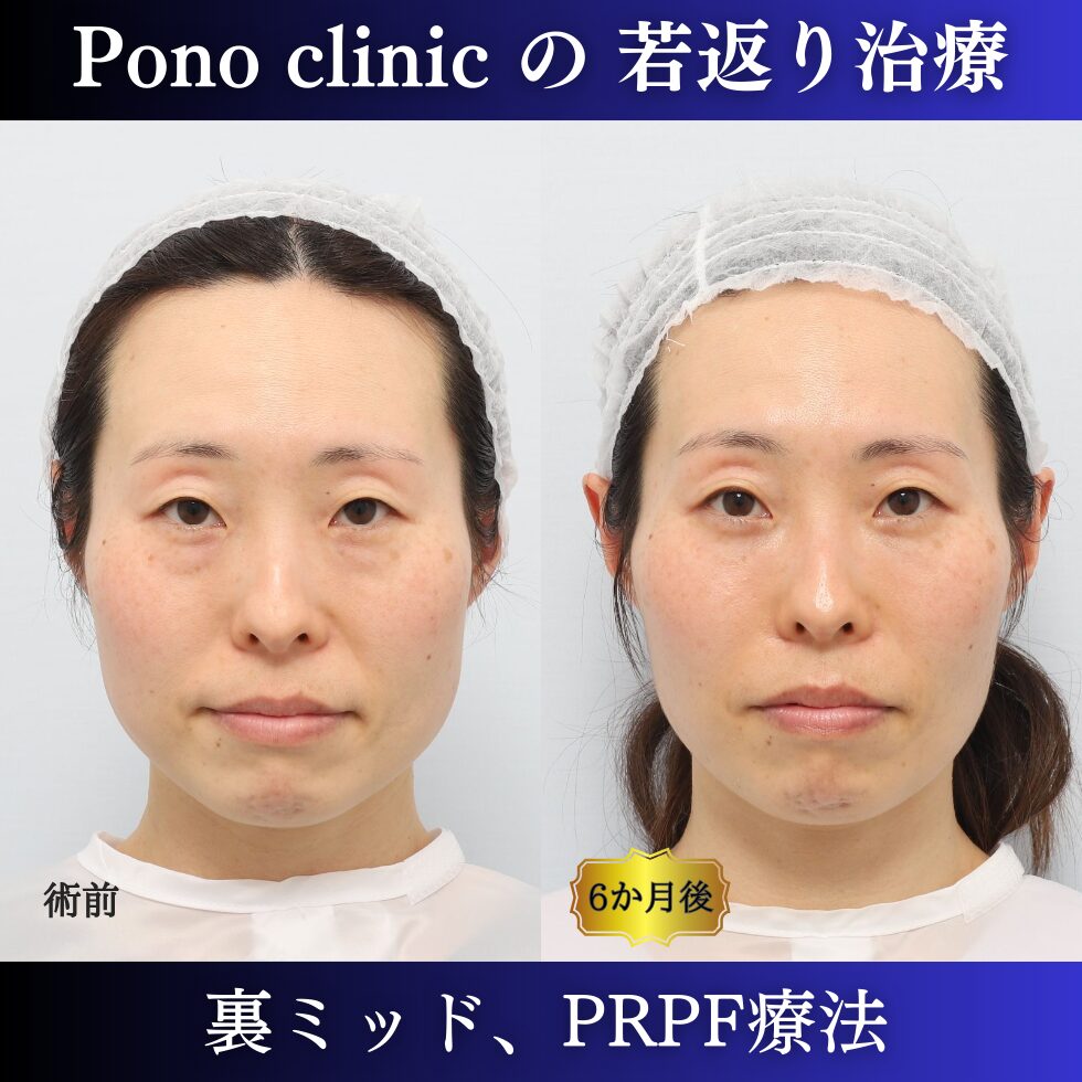 裏ミッドフェイスリフト、PRPF療法