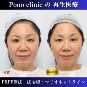 PRPF療法