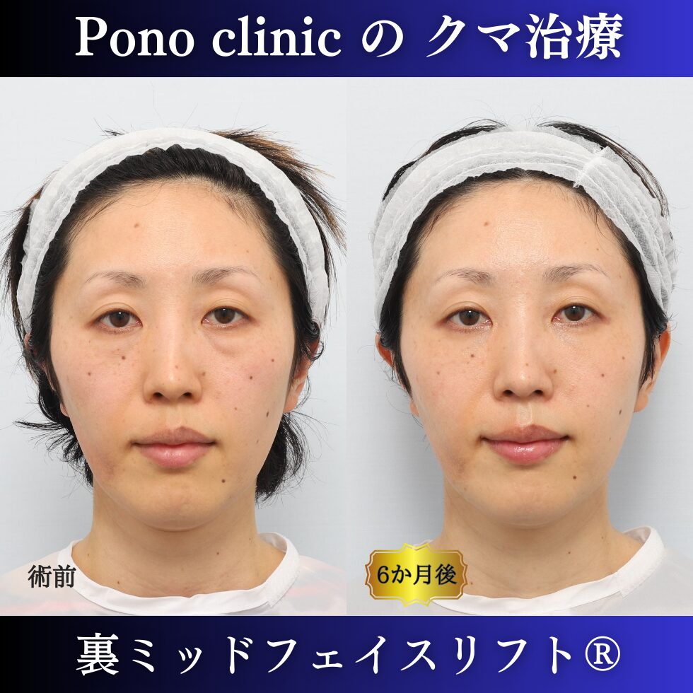 裏ミッドフェイスリフト