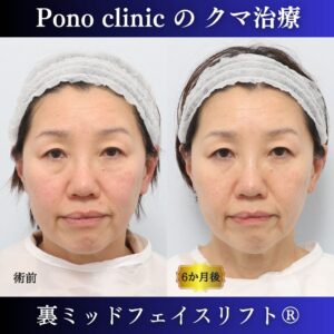裏ミッドフェイスリフト