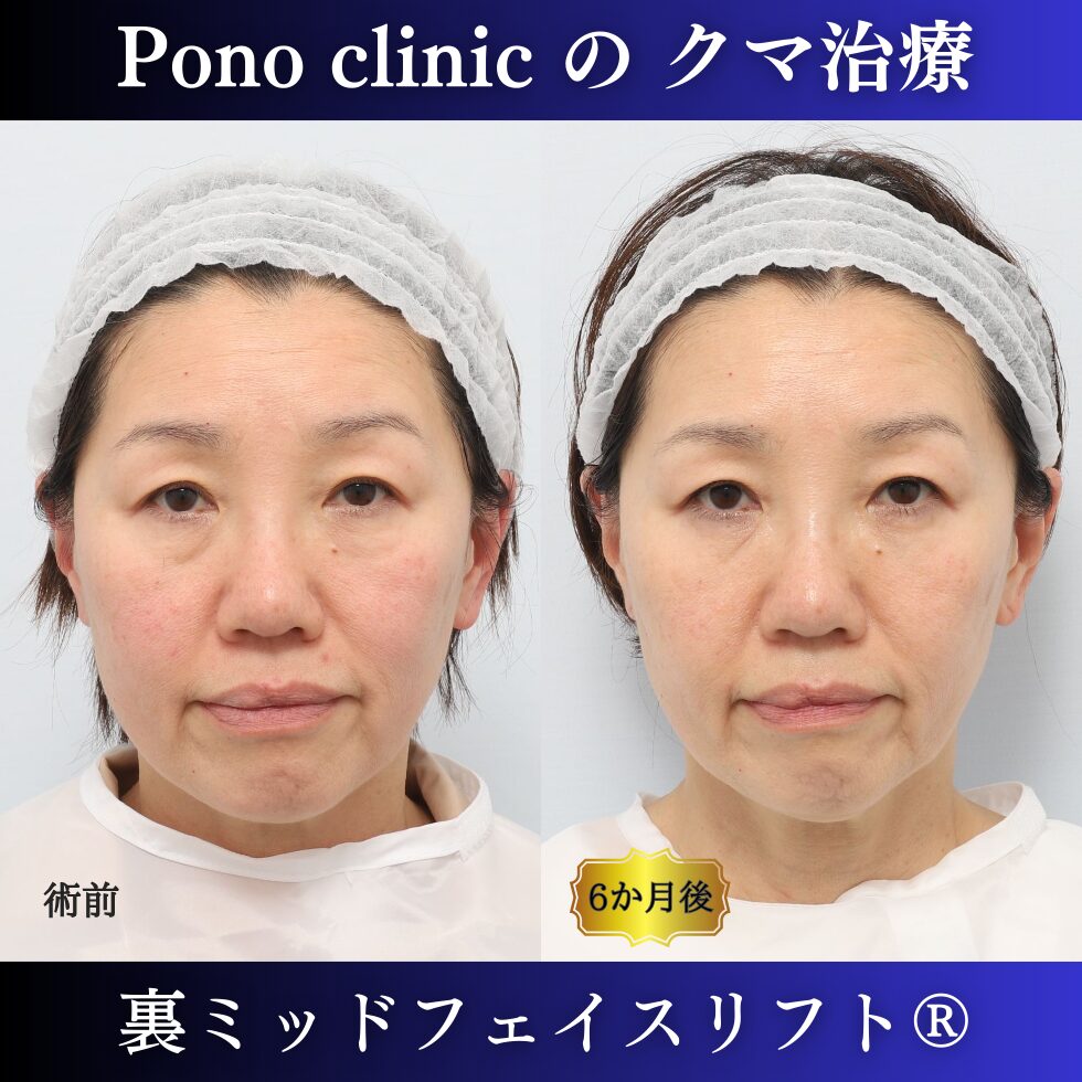 裏ミッドフェイスリフト