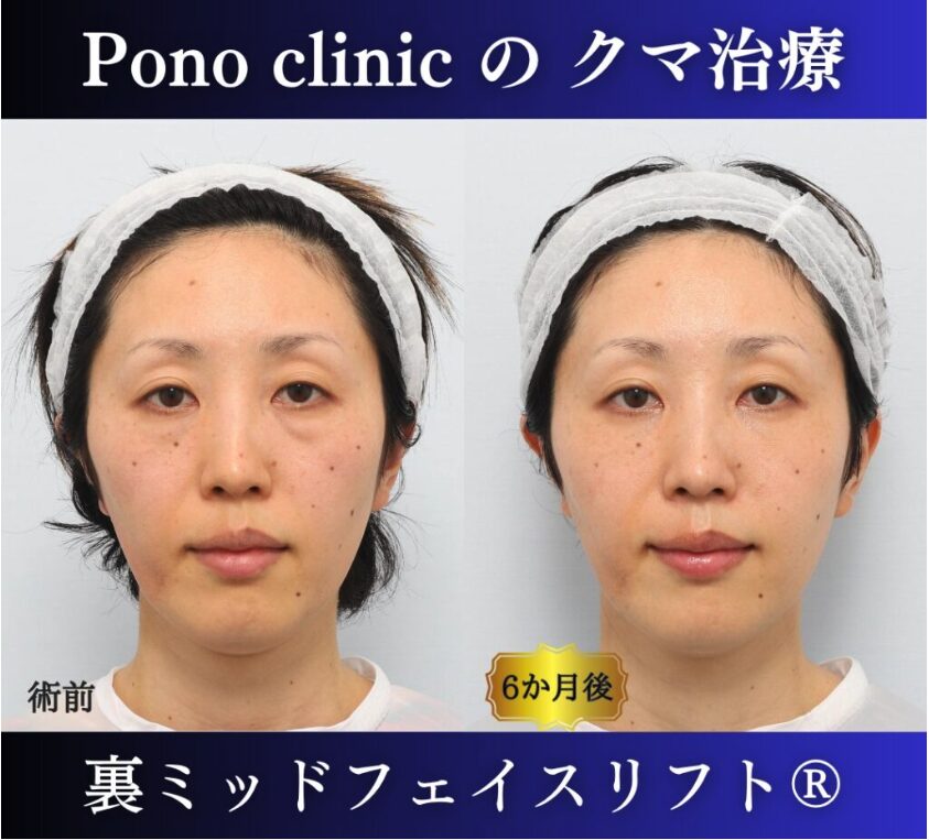 30代女性、目の下のクマ、裏ハムラ、ミッドフェイスリフト、クマ取り (7)