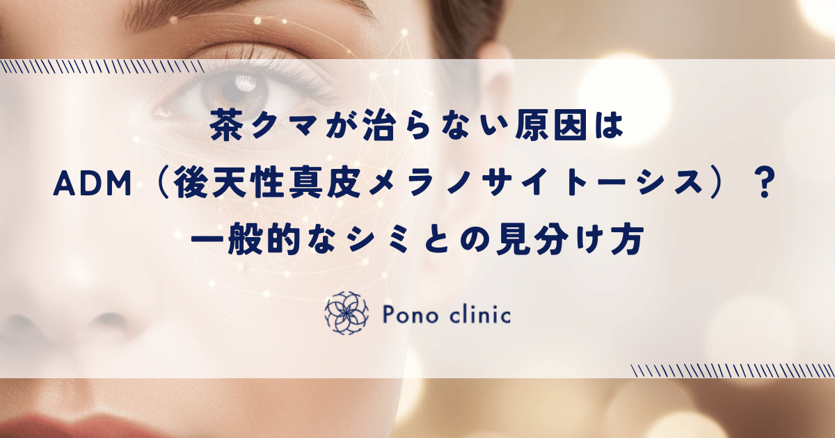 茶クマが治らない原因はADM（後天性真皮メラノサイトーシス）？一般的なシミとの見分け方