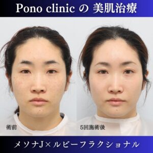 メソナ、ルビーフラクショナル