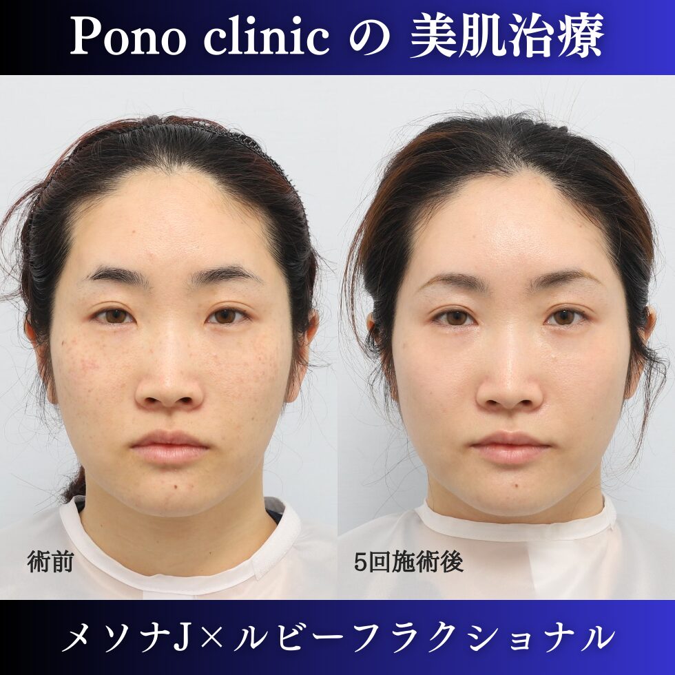 メソナ、ルビーフラクショナル