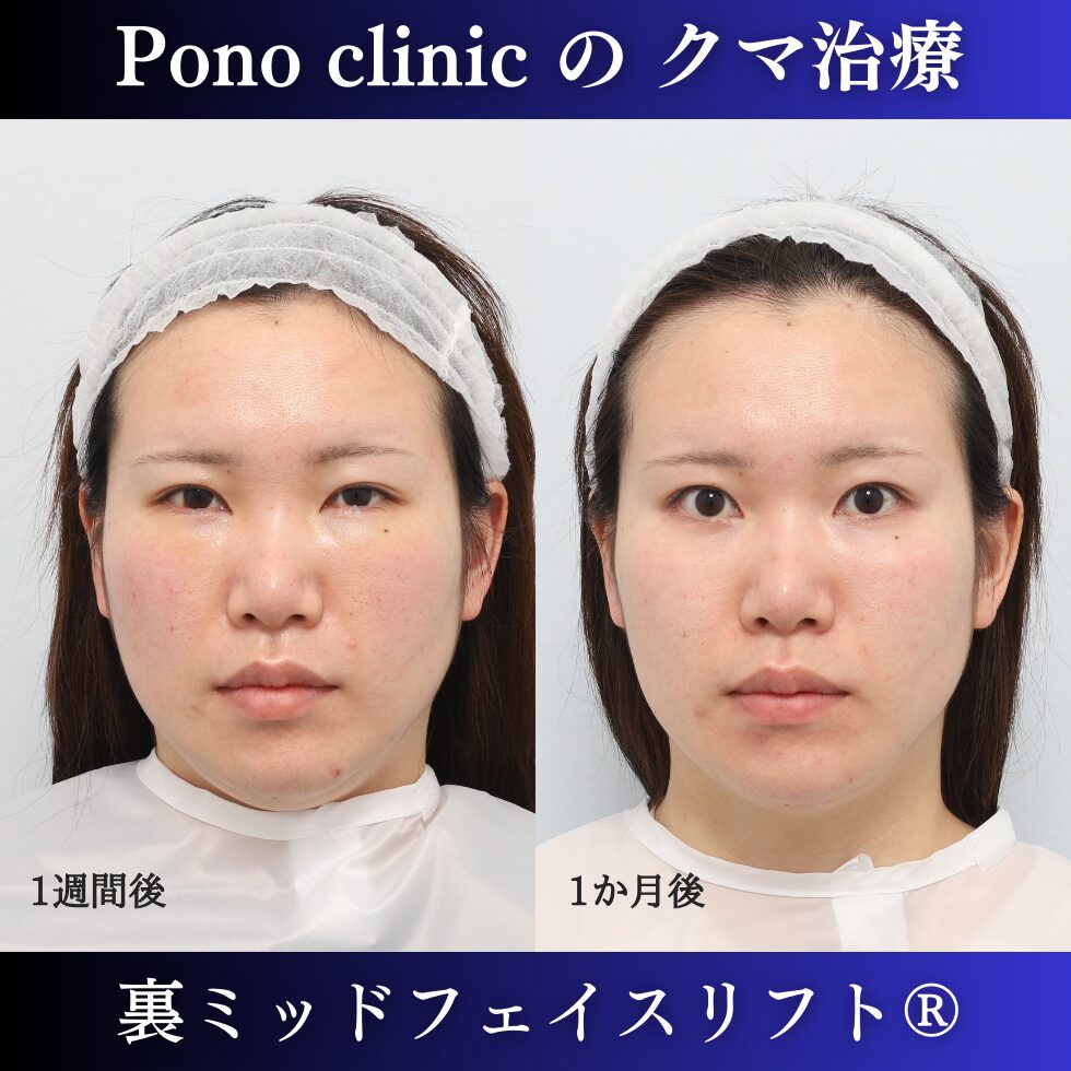 目の下のクマ治療、裏ハムラ、裏ミッドフェイスリフト、20代症例 (1)