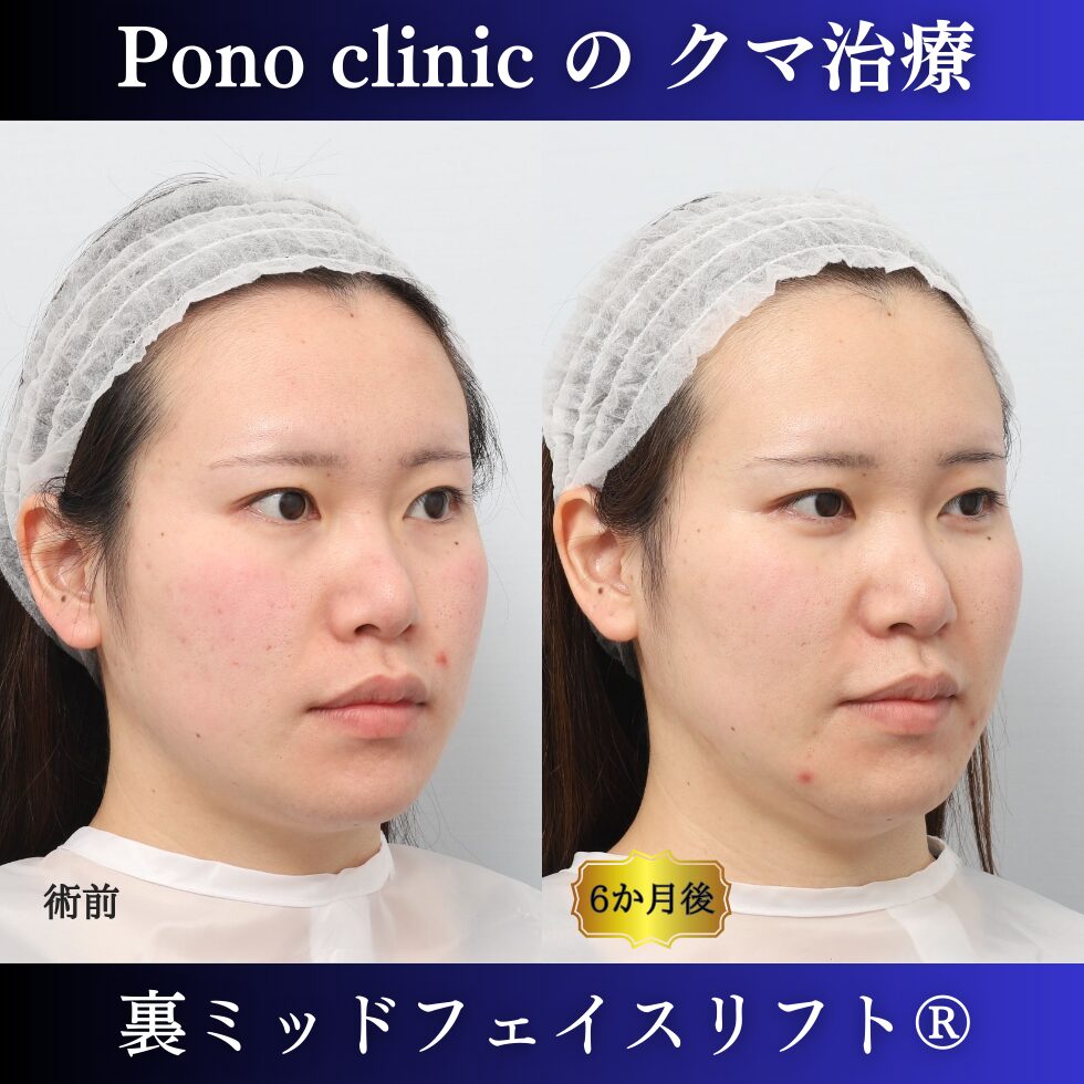 目の下のクマ治療、裏ハムラ、裏ミッドフェイスリフト、20代症例 (2)