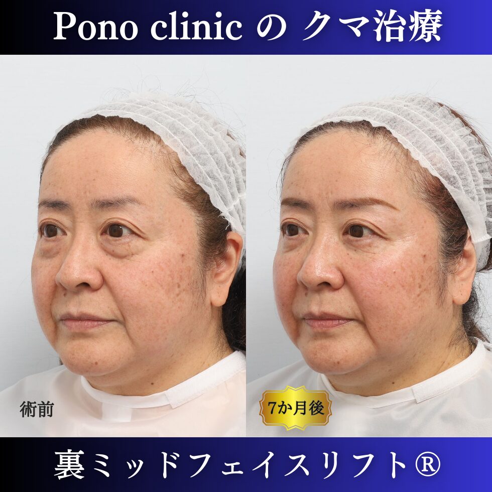 目の下のクマ、目の下のたるみ、クマ取り、裏ハムラ、裏ミッドフェイスリフト、50代症例 (3)