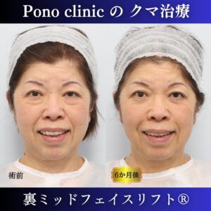 目の下のクマ、目の下のたるみ、裏ミッドフェイスリフト、60代症例 (4)