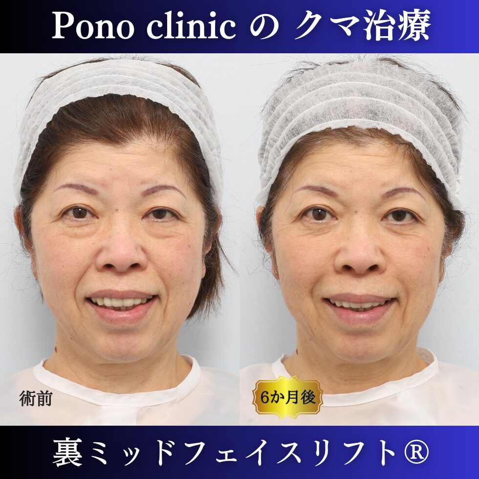 目の下のクマ、目の下のたるみ、裏ミッドフェイスリフト、60代症例 (4)