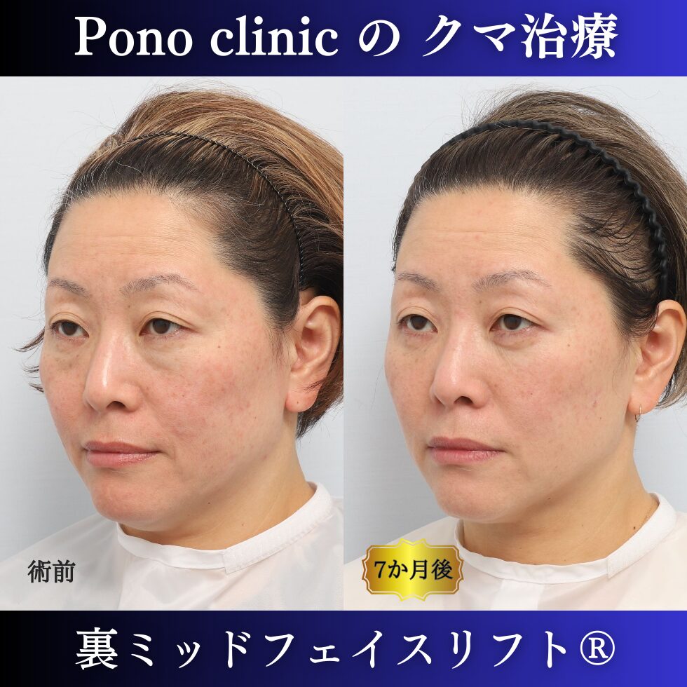 目の下のクマ治療、裏ミッドフェイスリフト、40代女性の症例 (3)