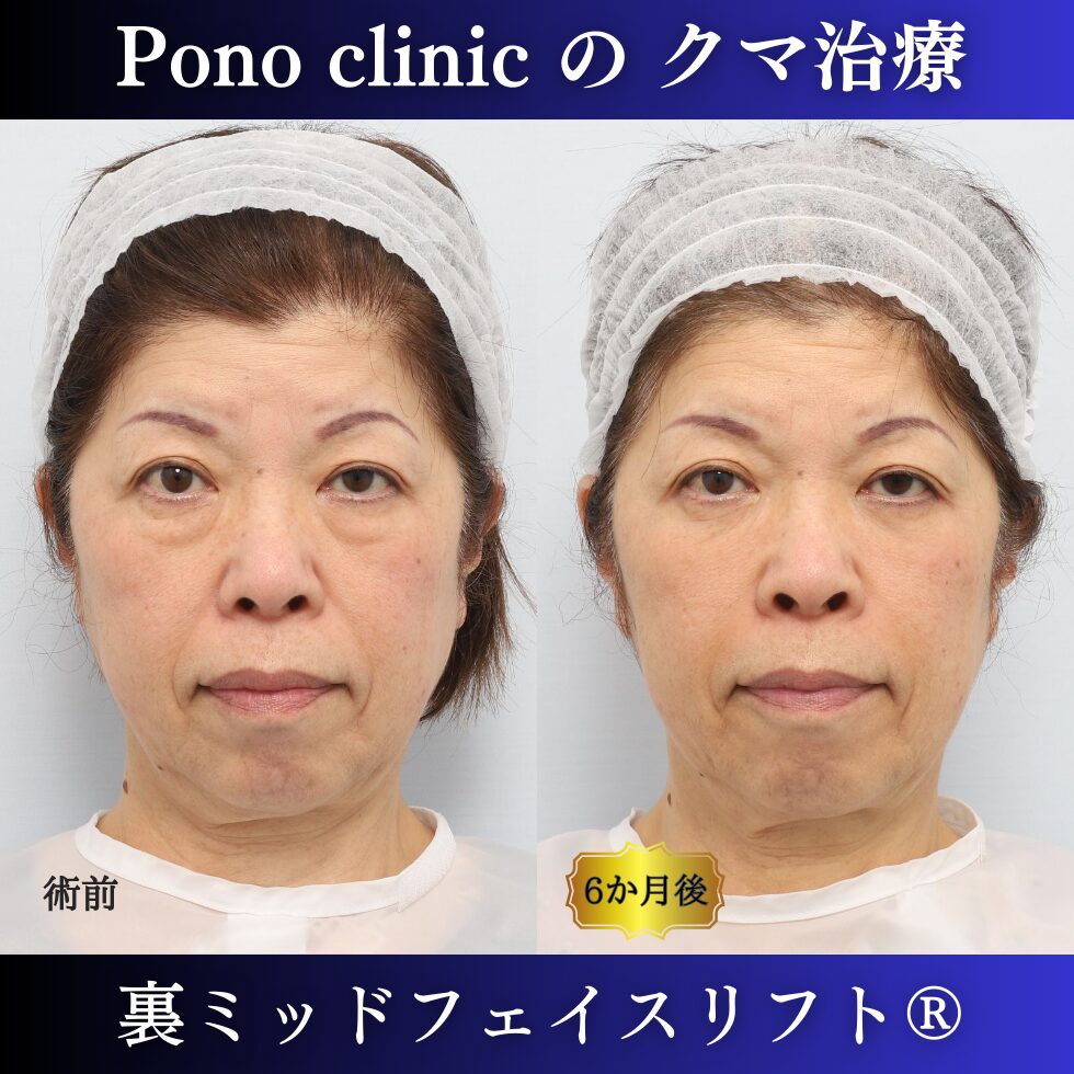 目の下のクマ、目の下のたるみ、裏ミッドフェイスリフト、60代症例 (7)