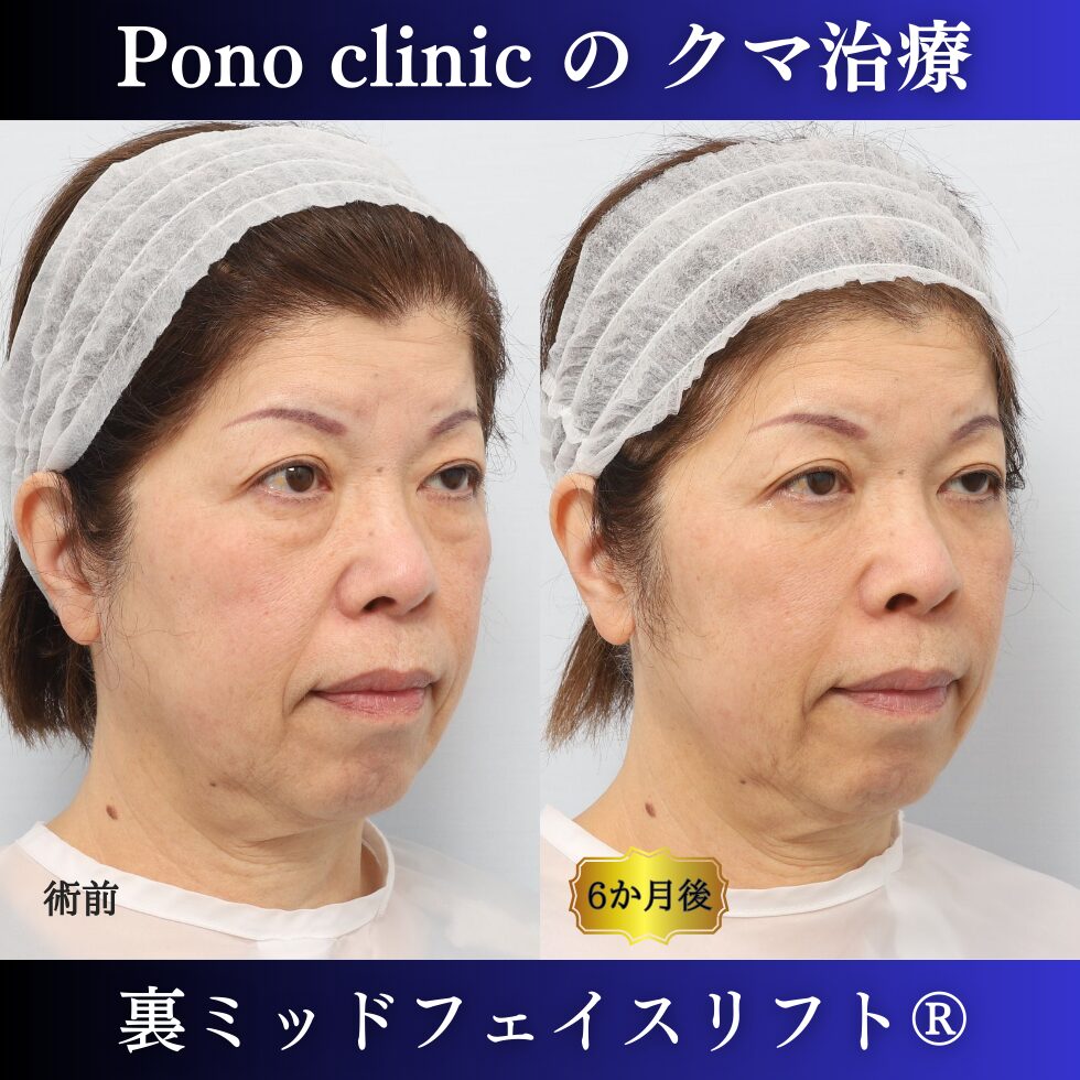 目の下のクマ、目の下のたるみ、裏ミッドフェイスリフト、60代症例 (2)