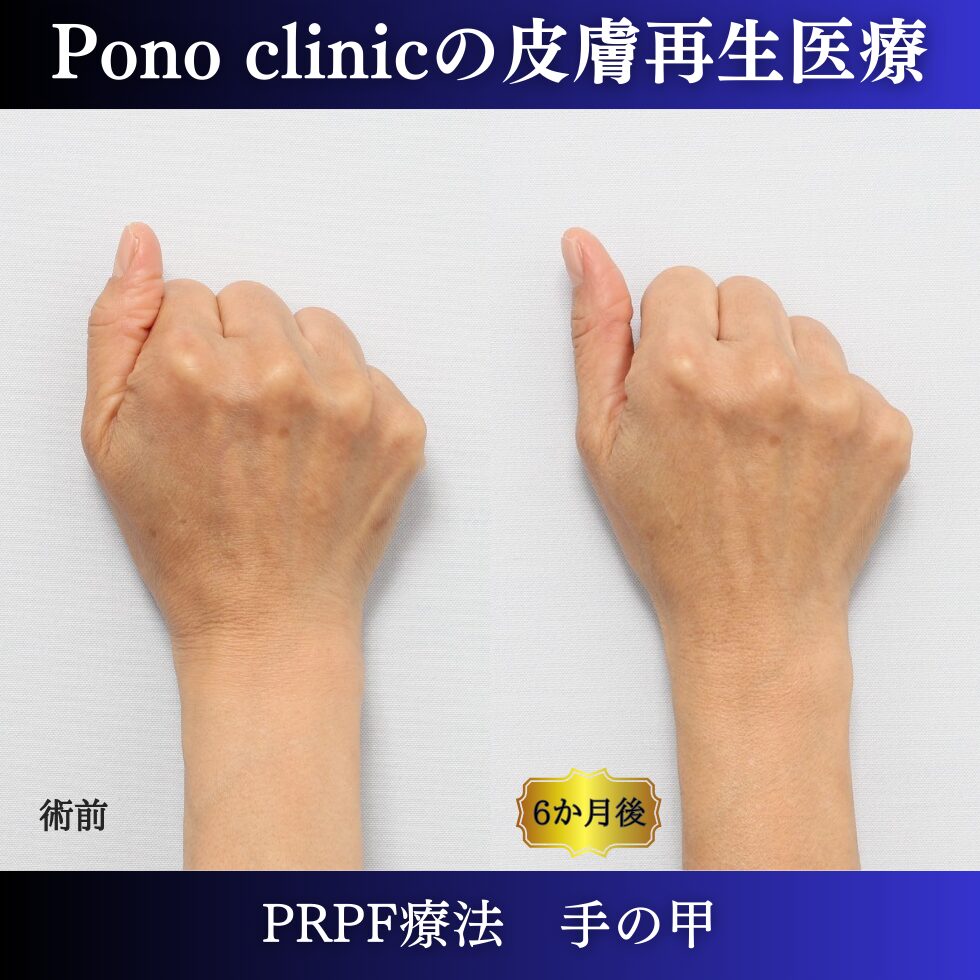 手の甲、PRPF療法、50代の症例 (1)