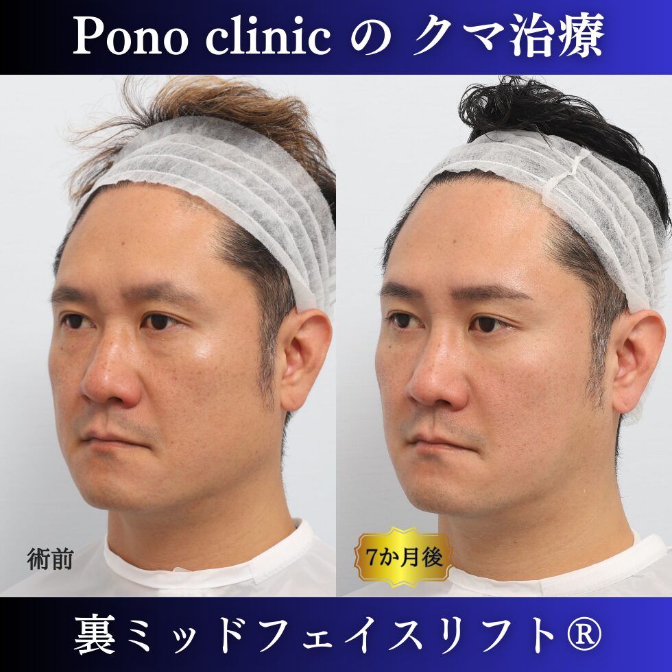 目の下のクマ取り、裏ミッドフェイスリフト、40代男性の症例 (3)