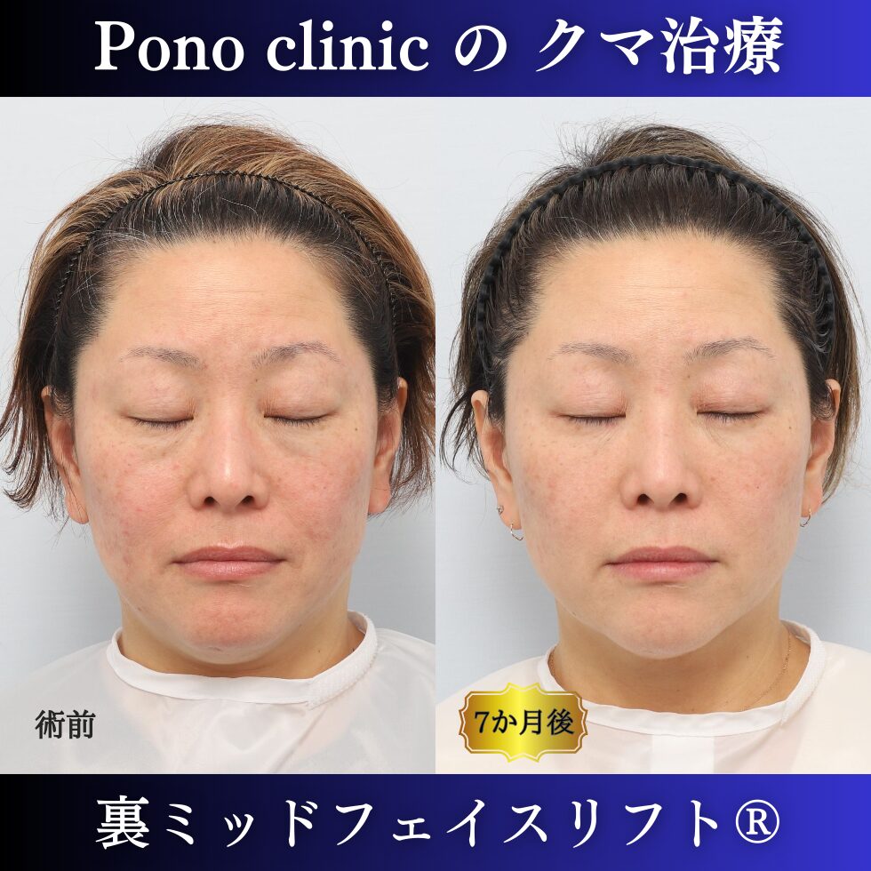 目の下のクマ治療、裏ミッドフェイスリフト、40代女性の症例 (6)