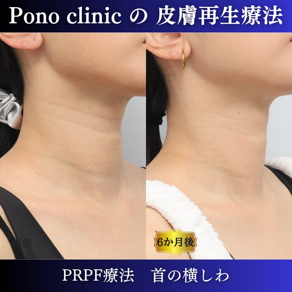 首のしわ、しわ治療、PRPF療法 、30代女性