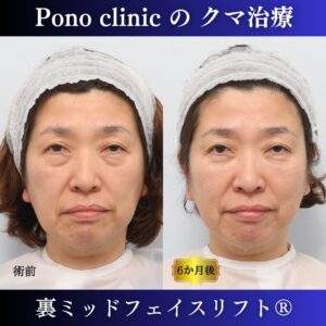 目の下のクマ、目の下のたるみ、クマ取り、裏ミッドフェイスリフト、50代症例 (7)