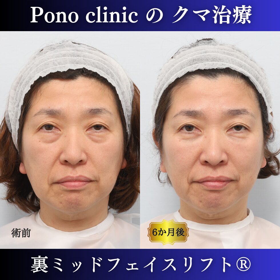 目の下のクマ、目の下のたるみ、クマ取り、裏ミッドフェイスリフト、50代症例 (7)