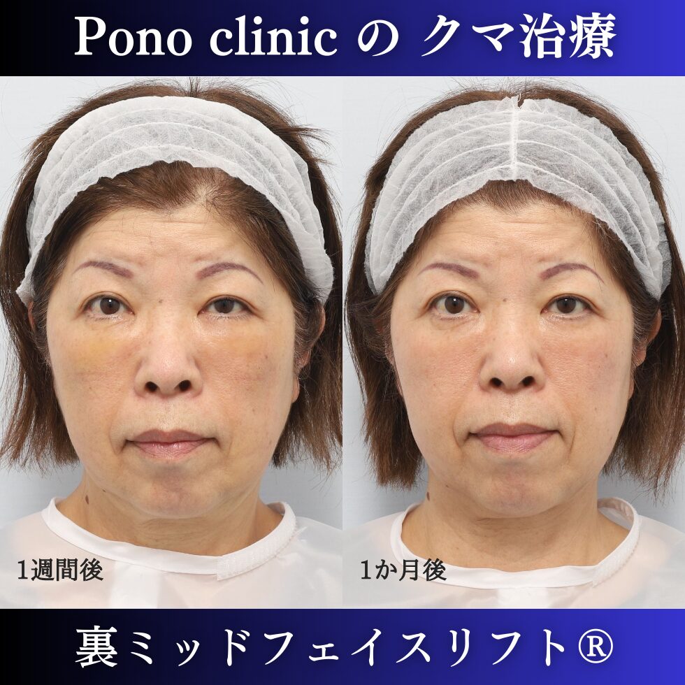 目の下のクマ、目の下のたるみ、裏ミッドフェイスリフト、60代症例 (1)