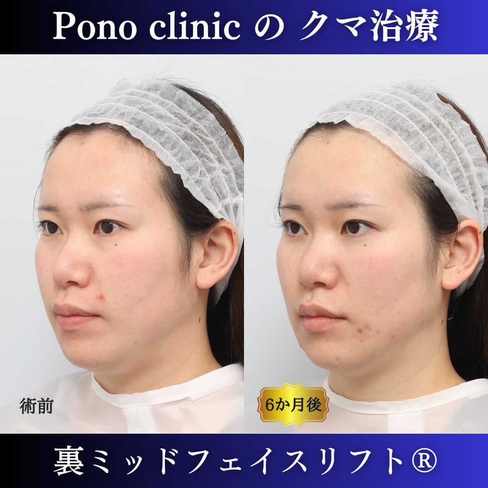 目の下のクマ治療、裏ハムラ、裏ミッドフェイスリフト、20代症例 (3)