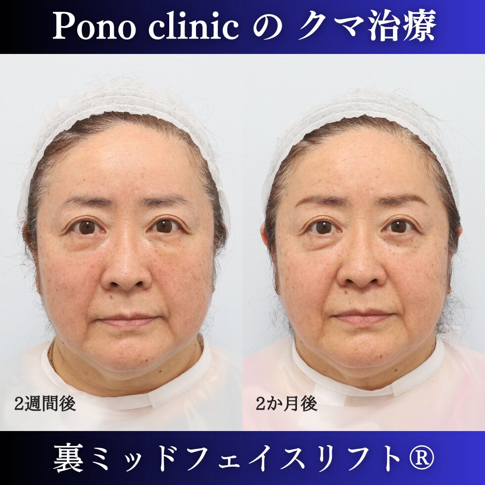 目の下のクマ、目の下のたるみ、クマ取り、裏ハムラ、裏ミッドフェイスリフト、50代症例 (1)