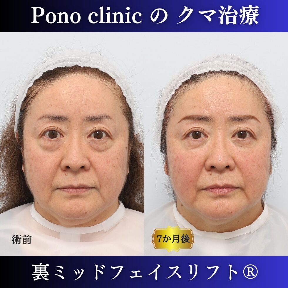 目の下のクマ、目の下のたるみ、クマ取り、裏ハムラ、裏ミッドフェイスリフト、50代症例 (7)