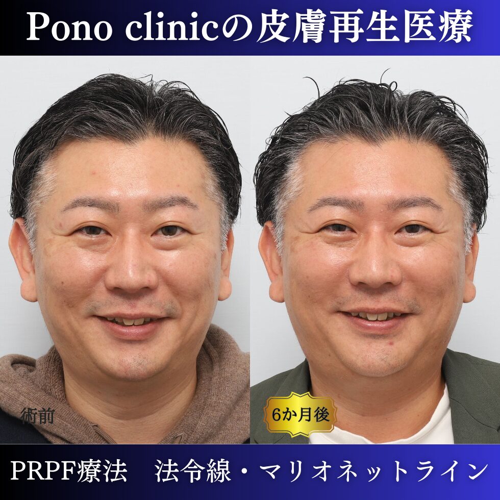 法令線、マリオネットライン、しわ治療、PRPF療法、40代男性の症例 (3)